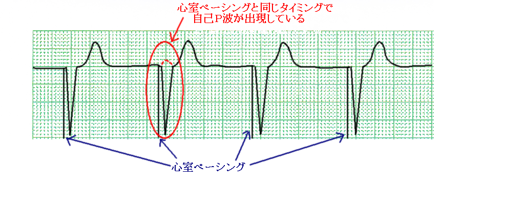 %e5%bf%83%e9%9b%bb%e5%9b%b3%e3%80%80%ef%bd%90%ef%bd%8d%e3%80%80%ef%bd%96%ef%bd%96%ef%bd%89%e3%80%80%ef%bd%90%ef%bd%8d%e7%97%87%e5%80%99%e7%be%a4