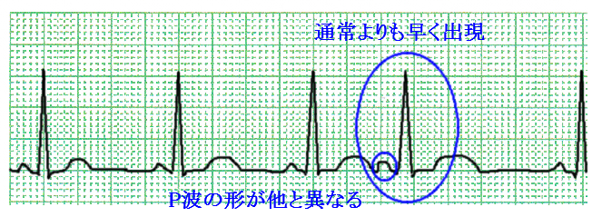 心室性期外収縮 ｐｖｃ と上室性期外収縮 ｐａｃ の違い 心電図を