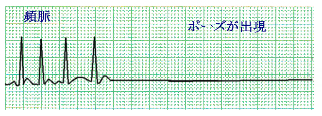 SSS(洞不全症候群)の心電図と看護とは：洞性徐脈・洞停止・洞房ブロック・徐脈頻脈症候群 看護師学習ノート