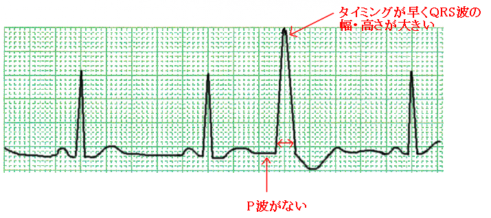 心室性期外収縮 Pvc の心電図とは 原因や発生時の対応 看護師学習ノート